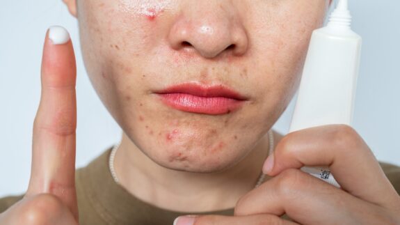 Retin-A applied to a pimple.