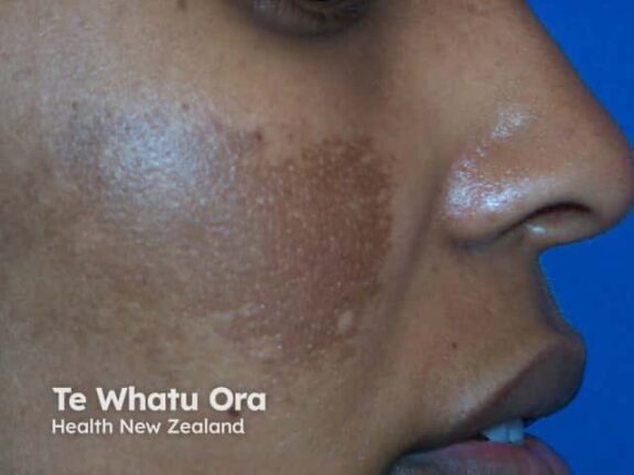 Skin whitening cream for melasma & pigmentation.