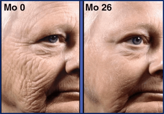 Tretinoin 0.25% cream before & after results.