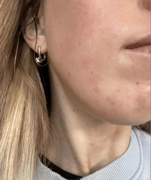 Tretinoin Uglies Reddit: Before & After photos showcasing skin improvement.
