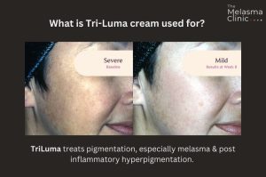 Tri Luma cream for hyperpigmentation treatment.