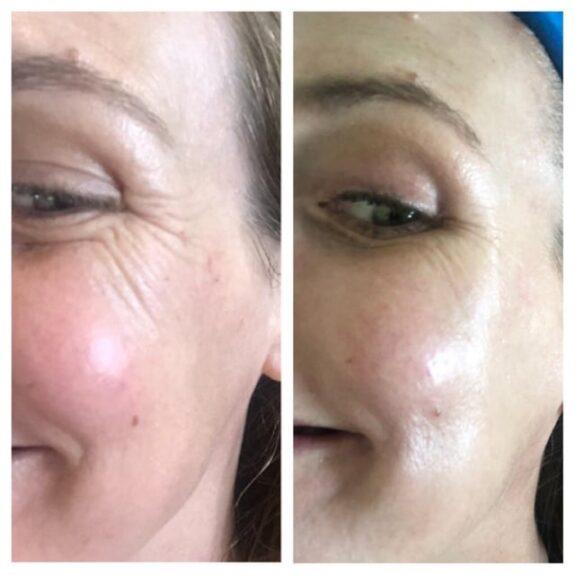 Tretinoin cream for crow's feet reduction.