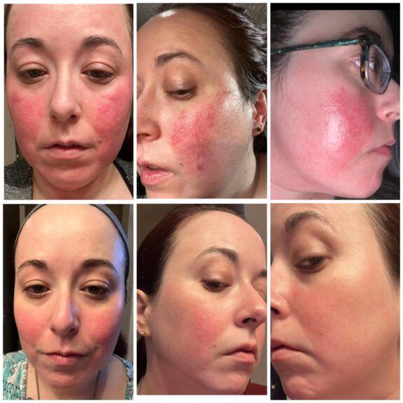 Tretinoin 0.025% cream for rosacea treatment.
