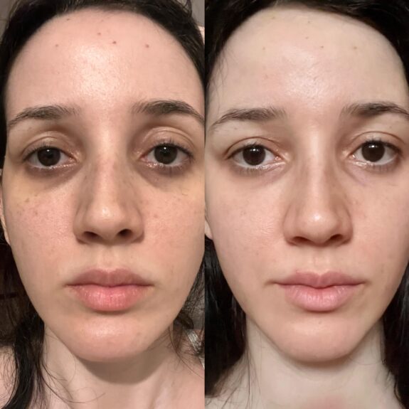 Tretinoin cream for dark circles under eyes.