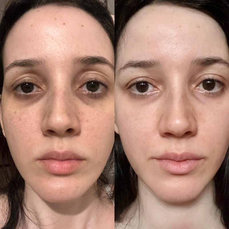 Tretinoin cream for dark circles under eyes.
