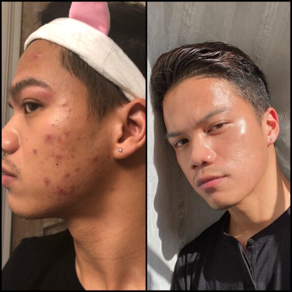 Tretinoin 0.1% cream tube.