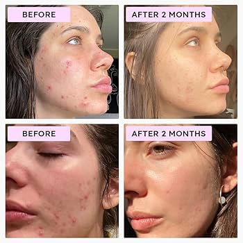Retinol & Azelaic Acid serum bottle