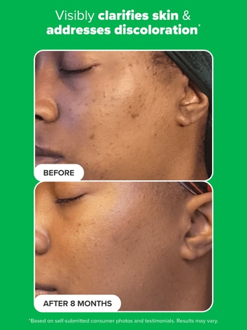 Paula's Choice Azelaic Acid: Before & After results.