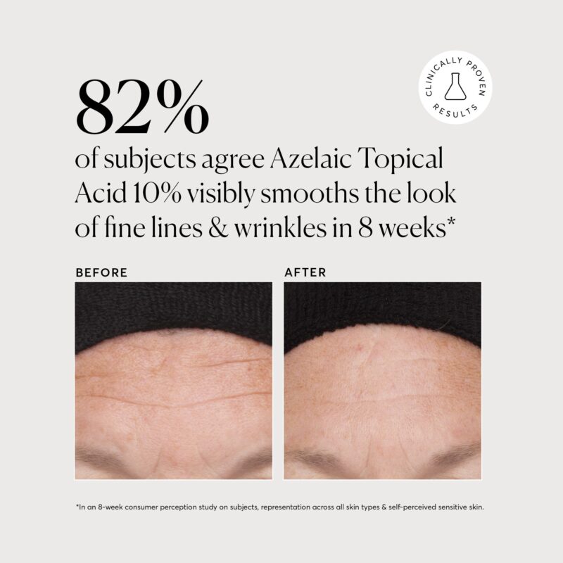 Before & After: Azelaic Acid treatment results.