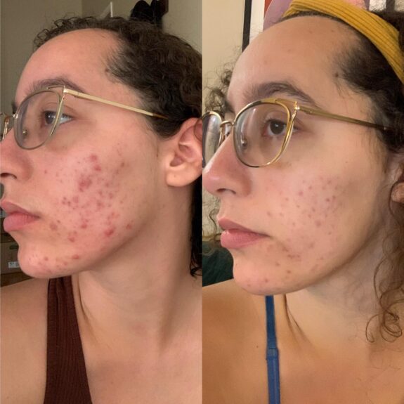 Tretinoin and azelaic acid skincare product.