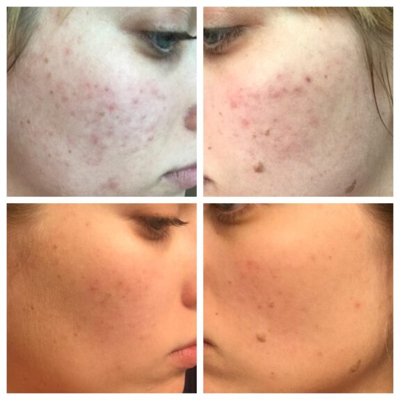 Reddit The Ordinary Azelaic Acid serum bottle
