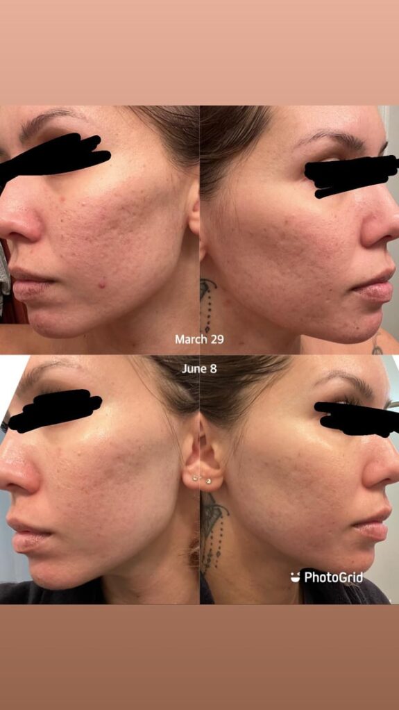 Tretinoin, Clindamycin, Azelaic Acid topical treatment.