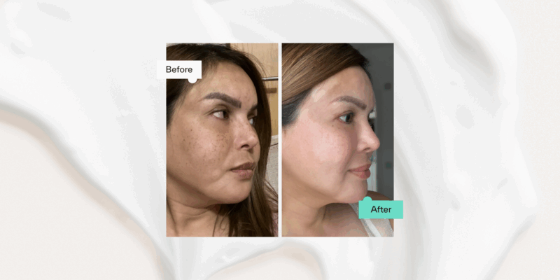 Azelaic acid before & after rosacea treatment results.