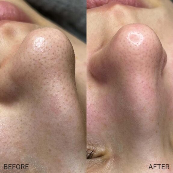 Azelaic acid skin peeling: before & after photos showing improved skin texture.
