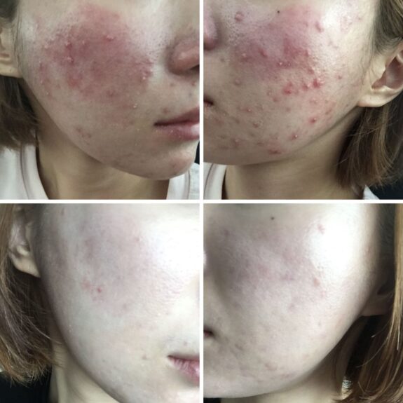Tretinoin & Azelaic Acid serum.