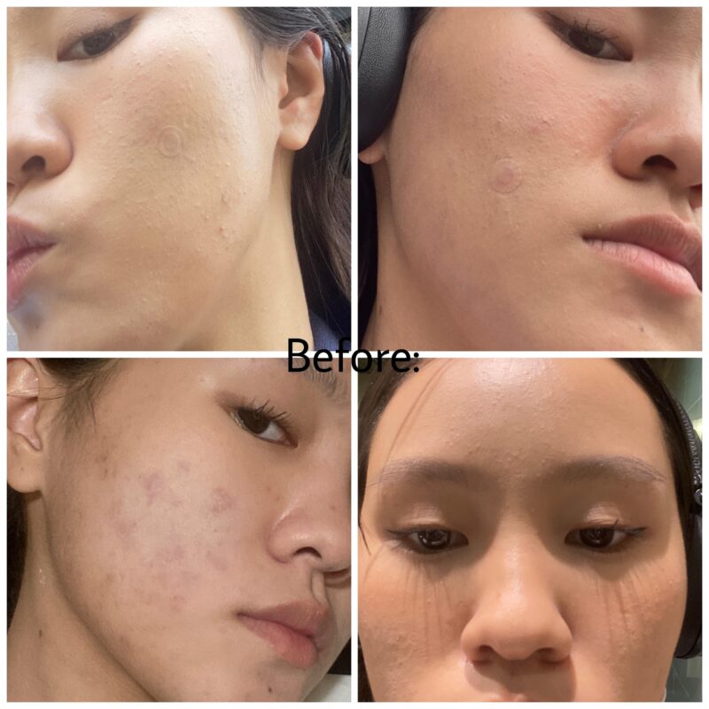 Skinoren before & after photos showing improved skin condition.