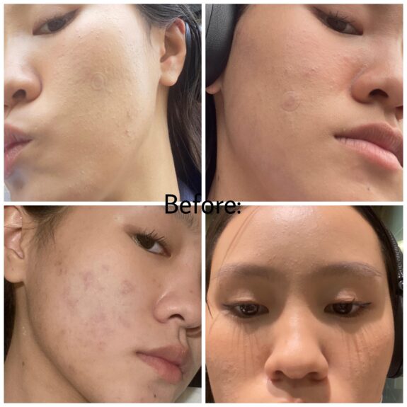 Skinoren Azelaic Acid before & after treatment photos showing improved skin.