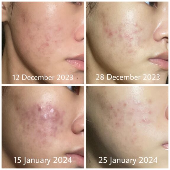 Before & after photos showcasing Skinoren cream's effectiveness on skin.