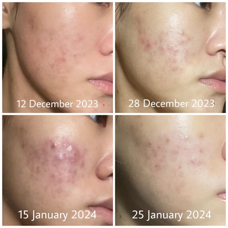 Skinoren Cream: Before & After results showing clearer skin.