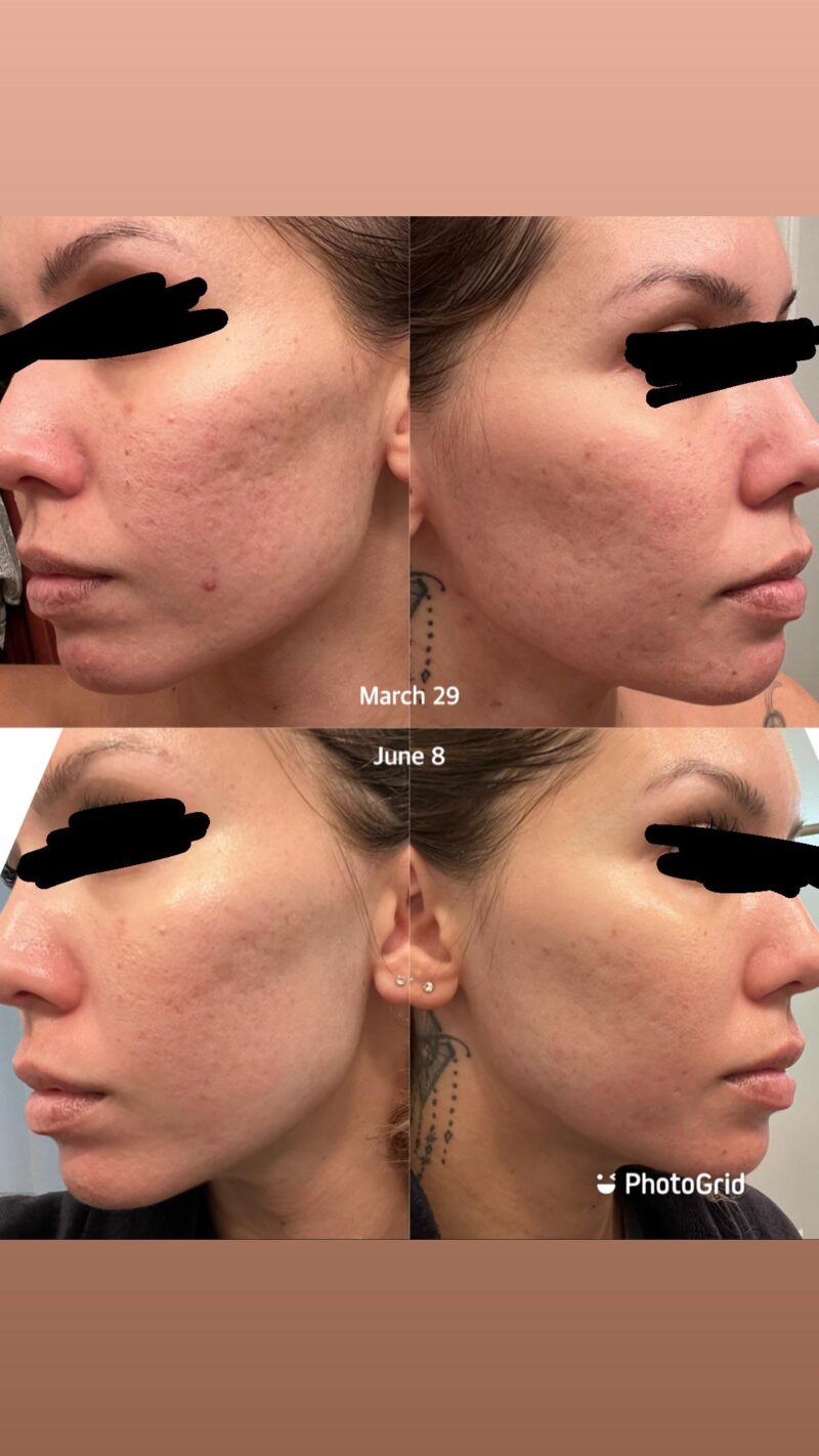 Curology tretinoin, clindamycin, azelaic acid topical treatment.