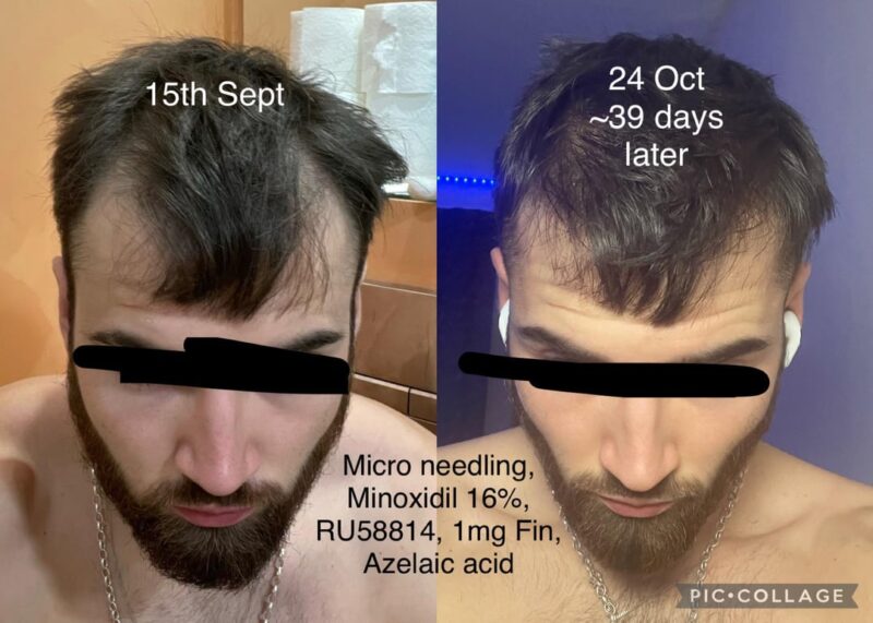 Azelaic acid hair loss treatment serum bottle