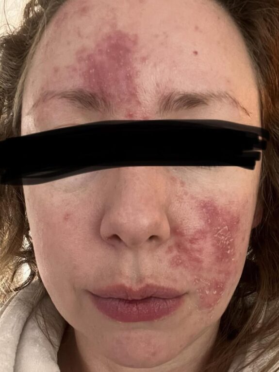 Azelaic acid treatment for rosacea.
