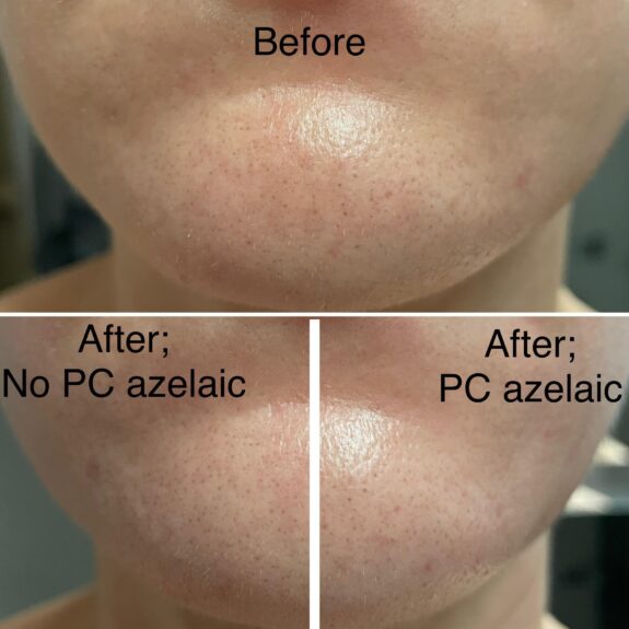 Paula's Choice Azelaic Acid before & after results.