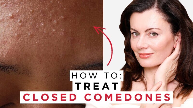 Closed Comedones Azelaic Acid treatment.