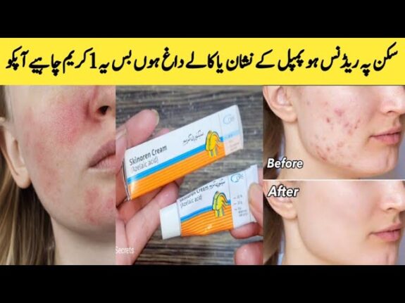 Skinoren cream for pigmentation treatment.