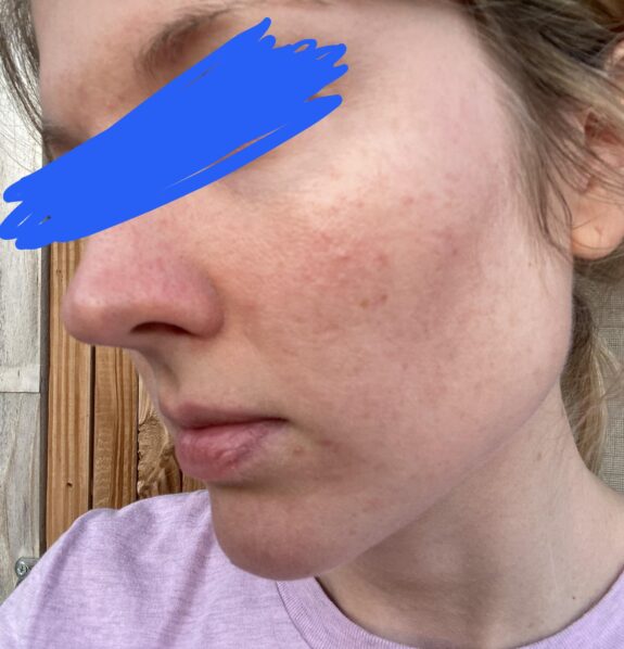 Soolantra and azelaic acid topical treatment combination.