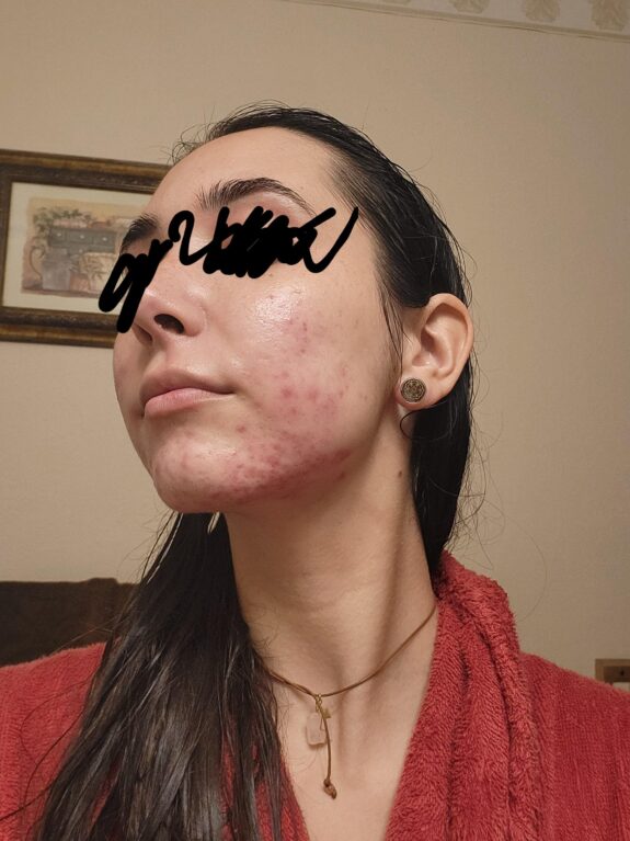 Tretinoin and azelaic acid cream.